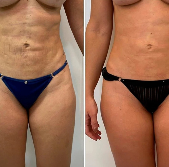 Resultado antes e depois 4
