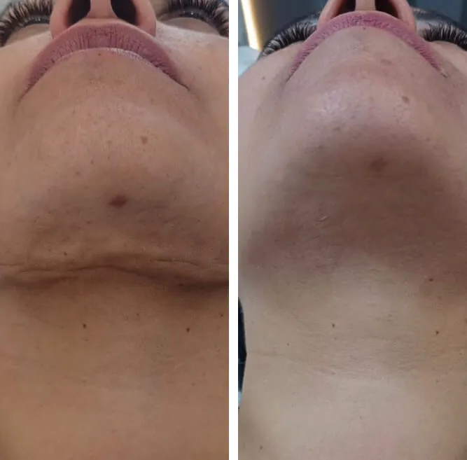 Resultado antes e depois 1