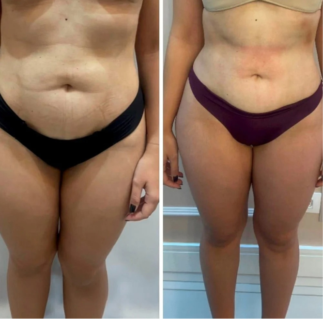 Resultado antes e depois 5