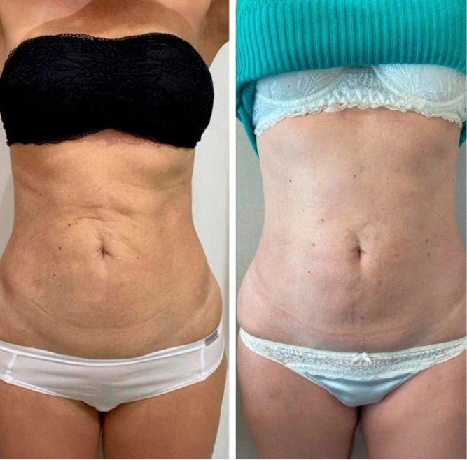 Resultado antes e depois 2