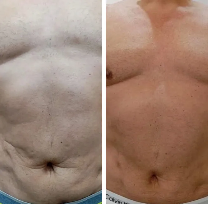 Resultado antes e depois 3